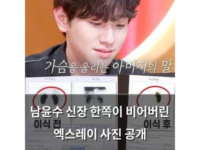 남윤수 신장 한쪽이 비어버린 엑스레이 사진 공개